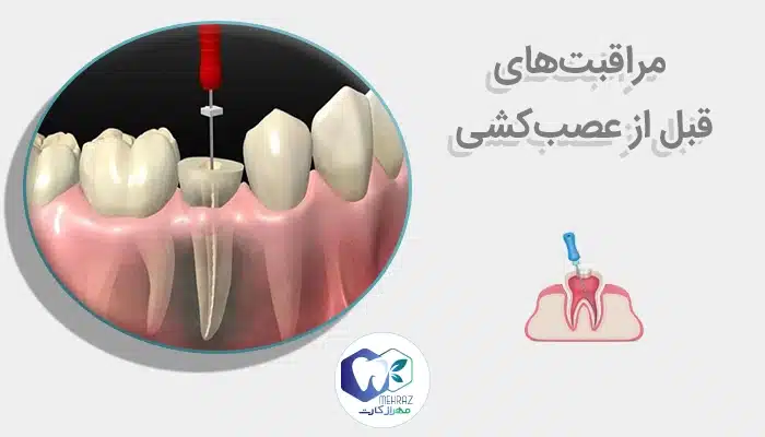 مراقبت‌های قبل از عصب‌کشی