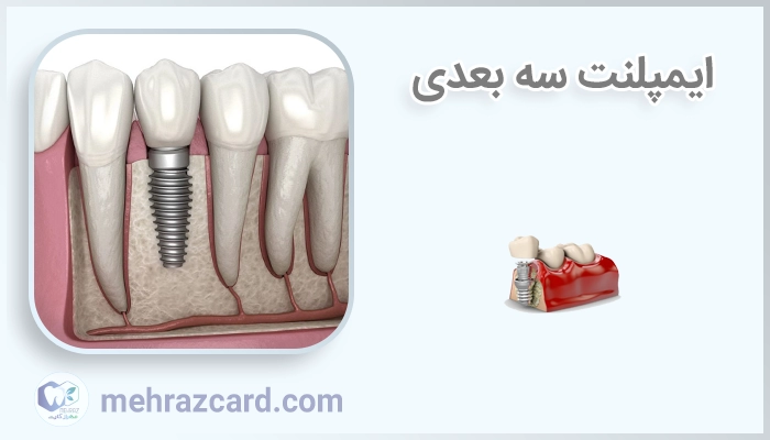 ایمپلنت سه بعدی