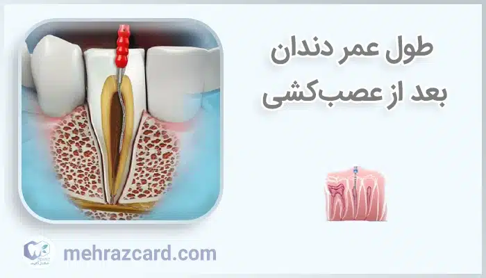 طول عمر دندان بعد از عصب‌کشی