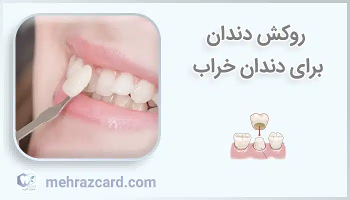 روکش دندان برای دندان خراب
