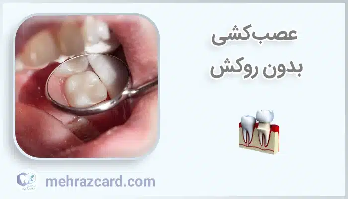 عصب‌کشی بدون روکش