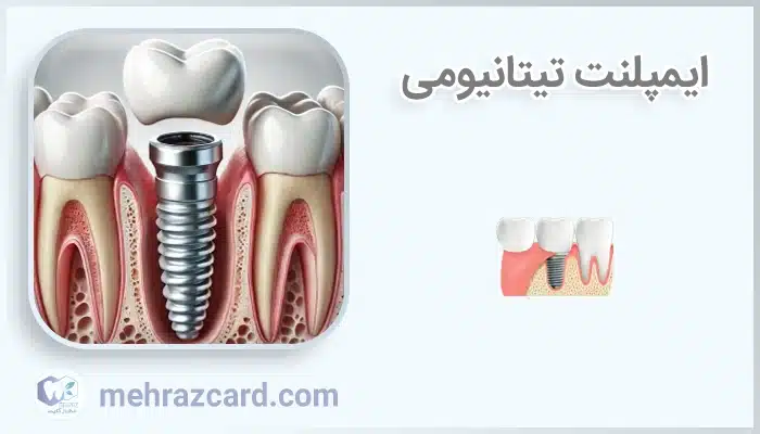 ایمپلنت تیتانیومی