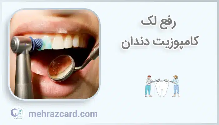 رفع لک کامپوزیت دندان
