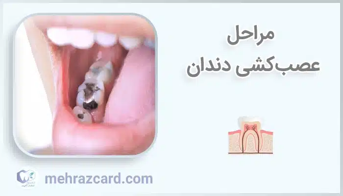 مراحل عصب‌کشی دندان