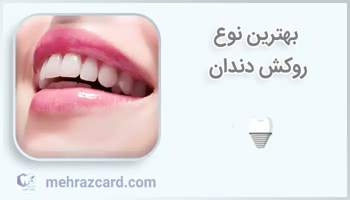 بهترین نوع روکش دندان