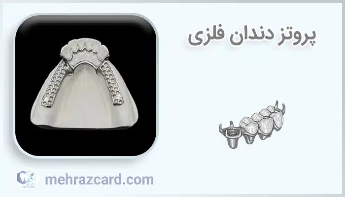 پروتز دندان فلزی