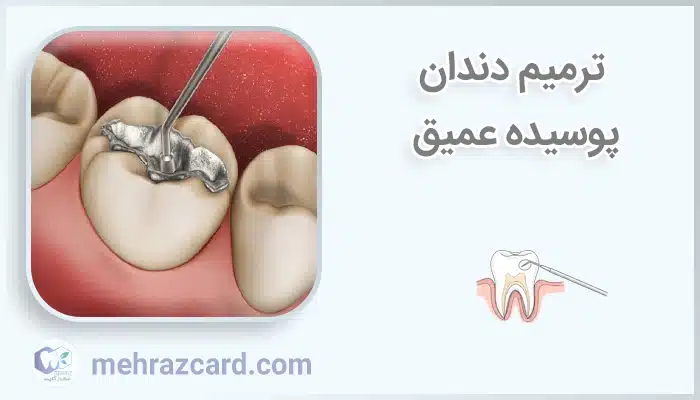 ترمیم دندان پوسیده عمیق