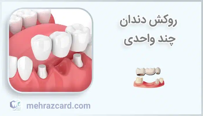 روکش دندان چند واحدی