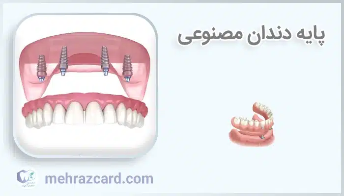 پایه دندان مصنوعی