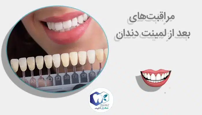 مراقبت‌های بعد از لمینت دندان