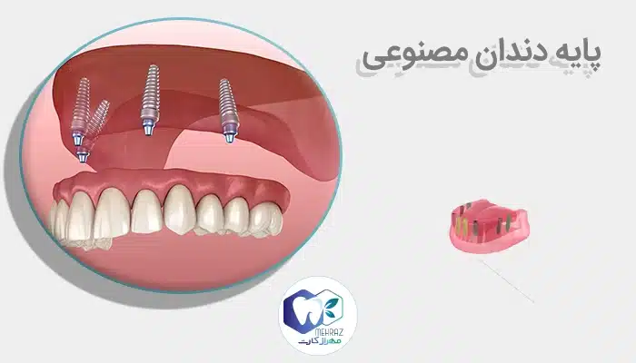 پایه دندان مصنوعی