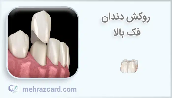 روکش دندان فک بالا
