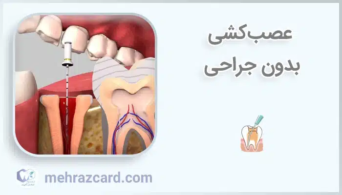 عصب‌کشی بدون جراحی