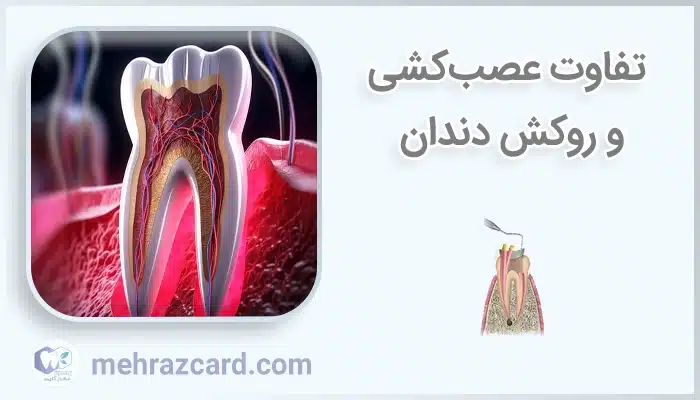 تفاوت عصب‌کشی و روکش دندان
