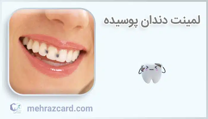 لمینت دندان پوسیده
