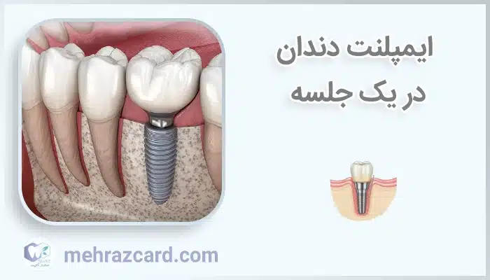 ایمپلنت دندان در یک جلسه