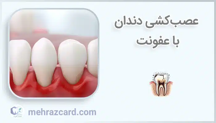 عصب‌کشی دندان با عفونت