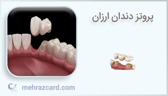 پروتز دندان ارزان